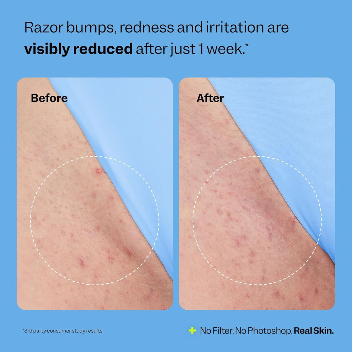 Elvado™ Razor Bump & Ingrown Hair Repair Roll-On